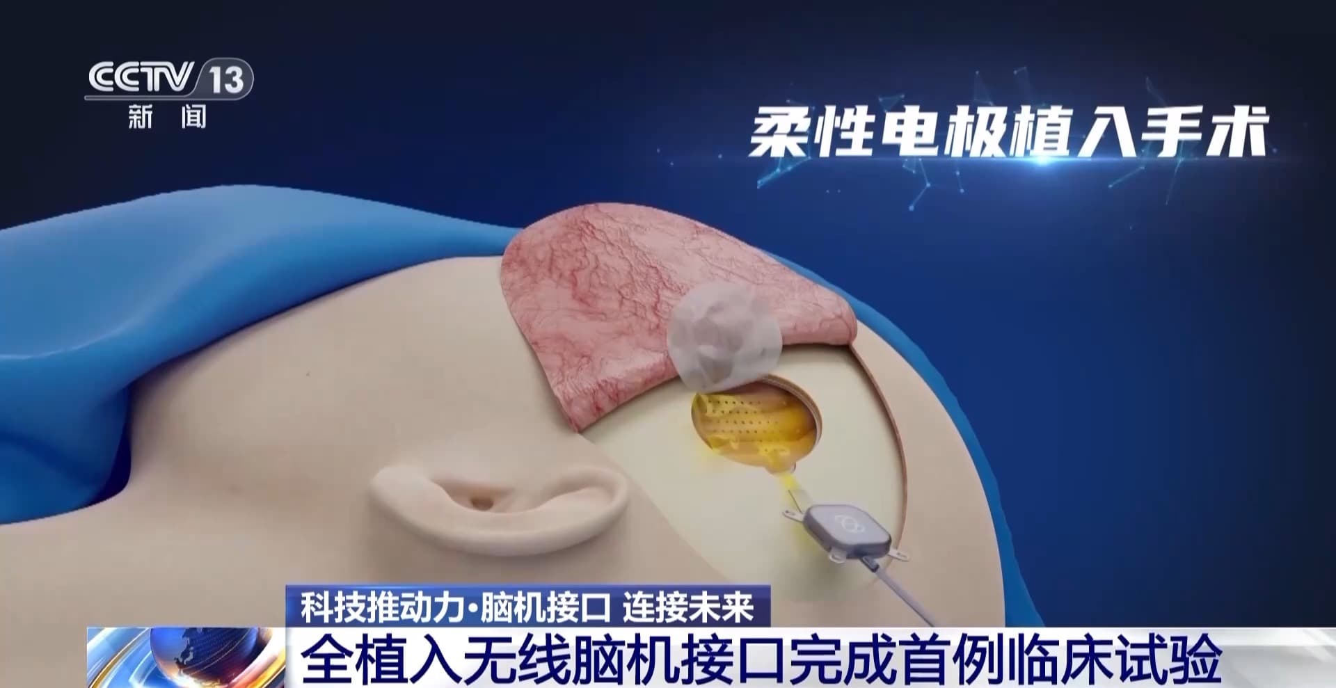 脑机接口革命：解锁人类大脑的新可能